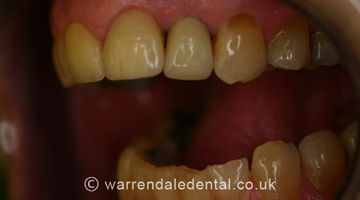 Dental Implants