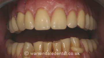 Dental Implants