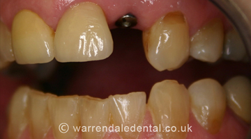 Dental Implants