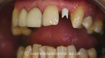 Dental Implants