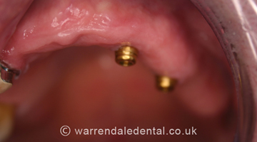 Dental Implants