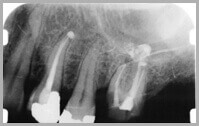 Dental X-ray