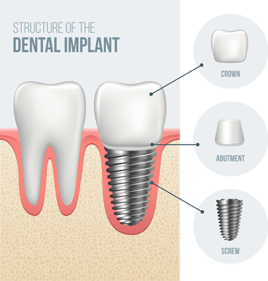 Structure of the Dental Implant